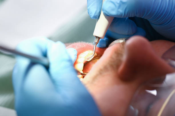 Best Chipped Tooth Repair Near Me  in Meridianville, AL
